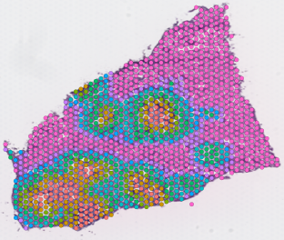 Squadrito_LiverTumor2022_Spatial